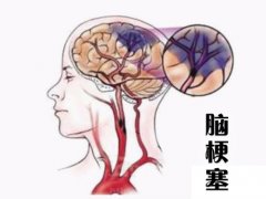 養(yǎng)成好的生活習慣，能夠有效預防腦梗塞
